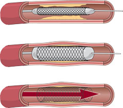 stent240x211